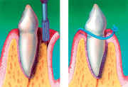 Perfect Smile surgical bone recontouring